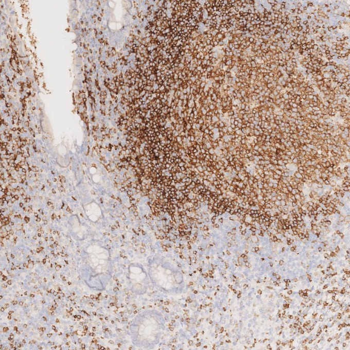 IHC staining of human appendicitis using 66103-1-Ig IHC staining of human appendicitis using 66103-1-Ig