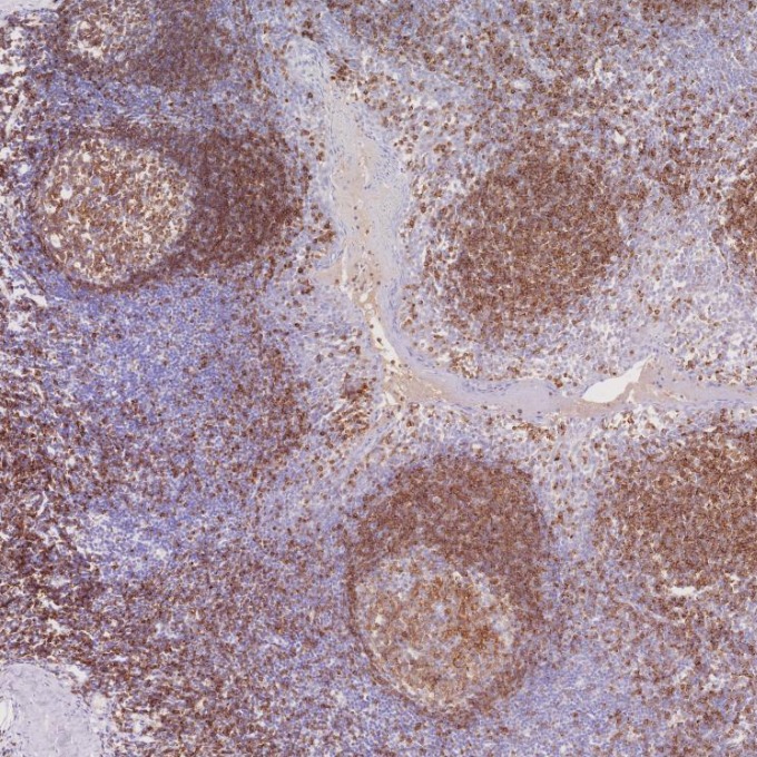 IHC staining of human tonsillitis using 66103-1-Ig IHC staining of human tonsillitis using 66103-1-Ig