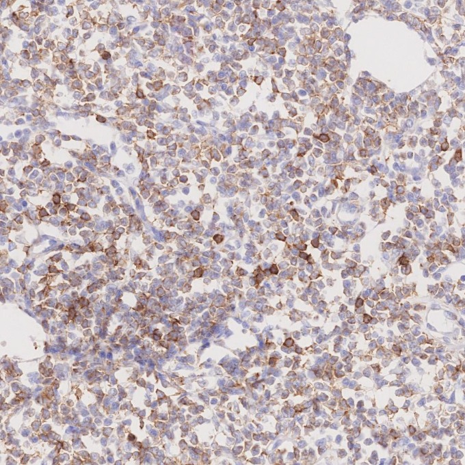 IHC staining of human lymphoma using 66103-1-Ig IHC staining of human lymphoma using 66103-1-Ig