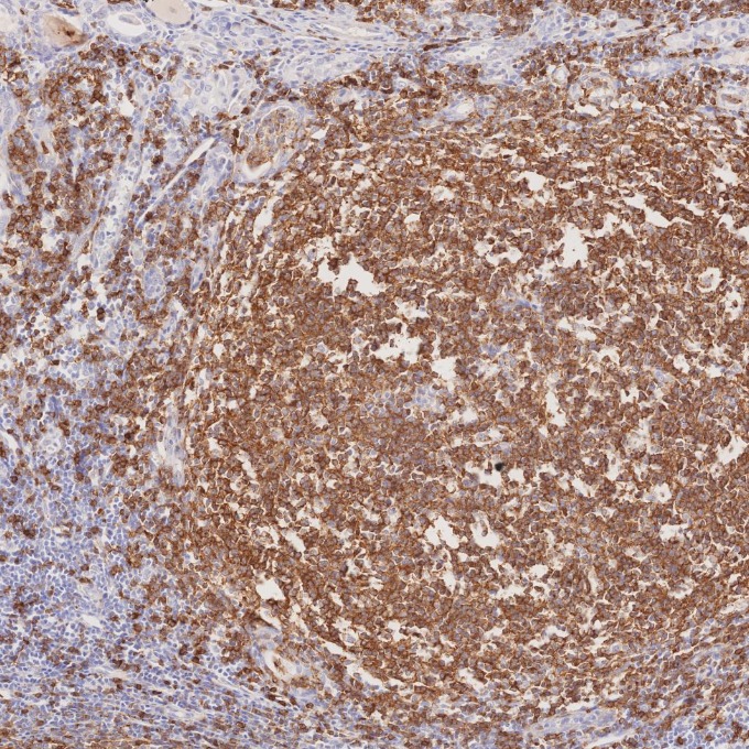 IHC staining of human lymphoma using 66103-1-Ig IHC staining of human lymphoma using 66103-1-Ig