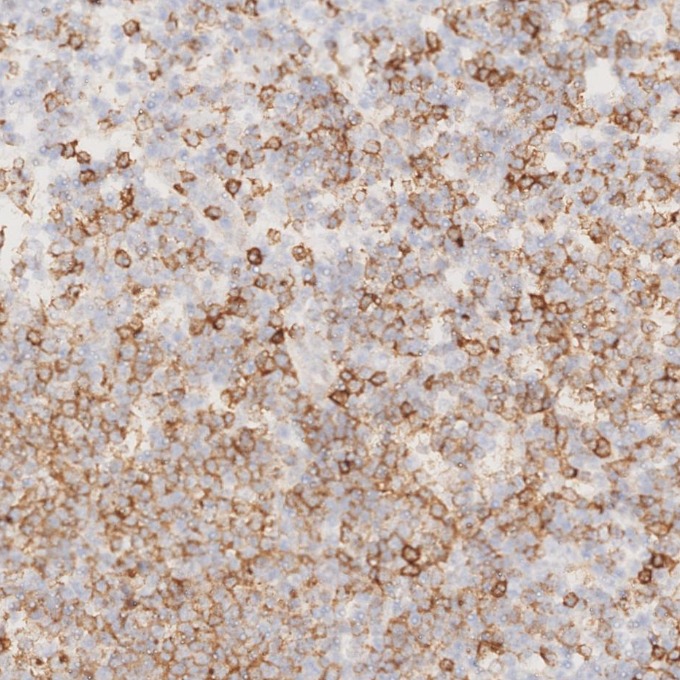 IHC staining of human lymphoma using 66103-1-Ig IHC staining of human lymphoma using 66103-1-Ig
