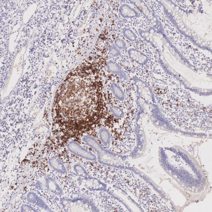 IHC staining of human lymphoma using 66103-1-Ig IHC staining of human lymphoma using 66103-1-Ig