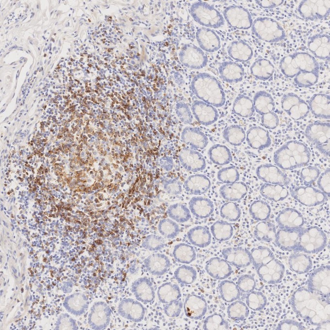 IHC staining of human lymphoma using 66103-1-Ig IHC staining of human lymphoma using 66103-1-Ig