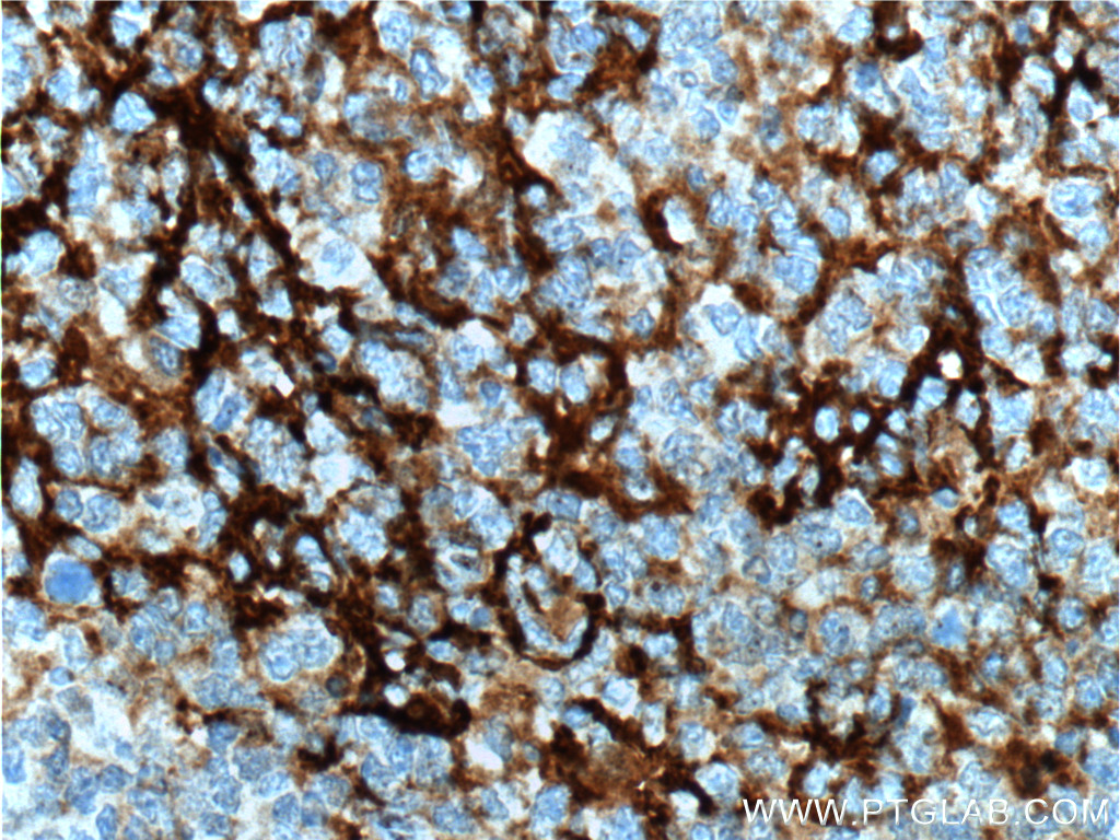 IHC staining of human tonsillitis using 10300-1-AP