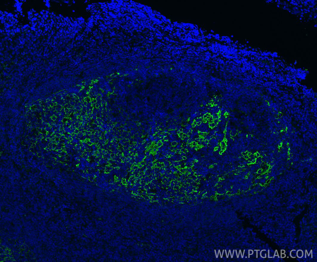 IF Staining of human tonsillitis using 60208-1-Ig