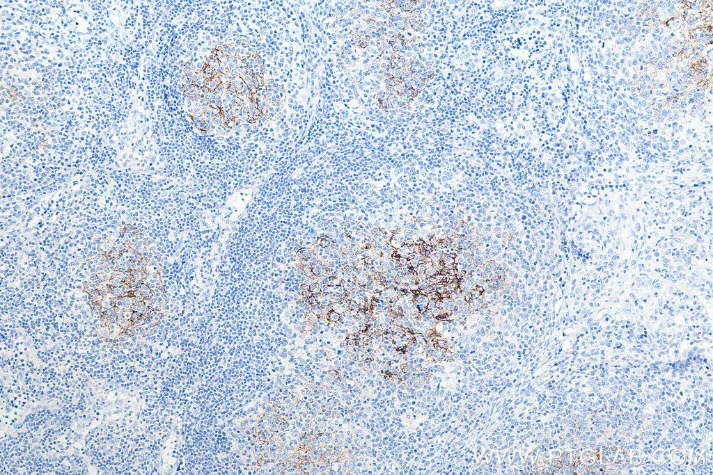 IHC staining of human lymphoma using 60208-2-Ig