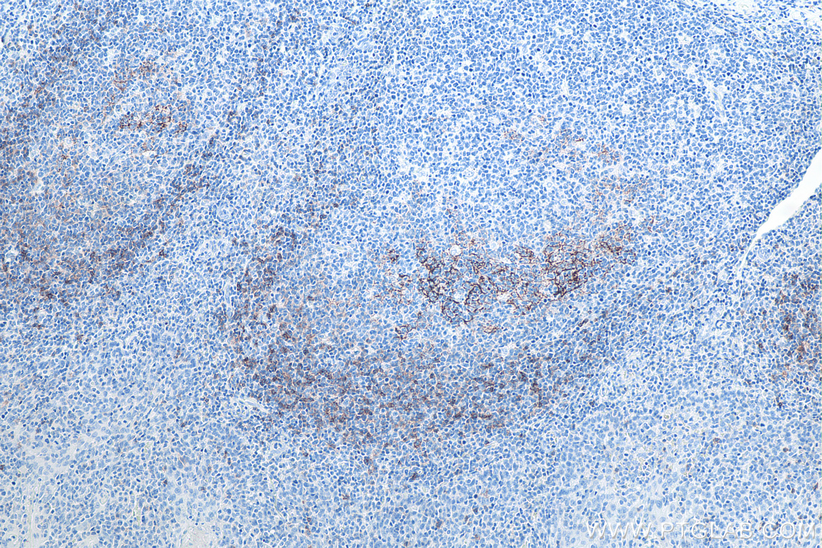 IHC staining of human tonsillitis using 60208-2-Ig