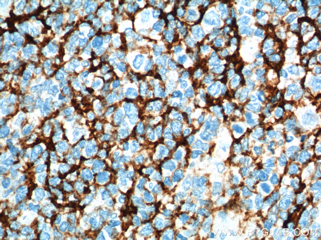 IHC staining of human tonsillitis using 60208-2-Ig