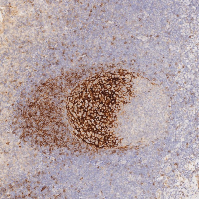 IHC staining of human tonsillitis using 60208-2-Ig