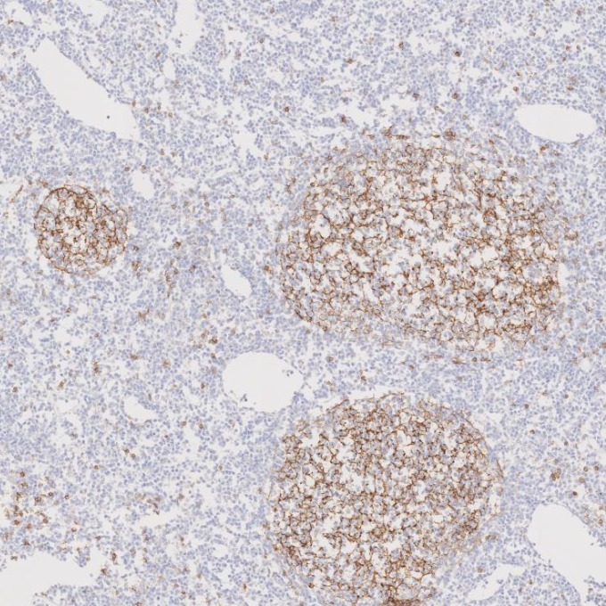 IHC staining of human lymphoma using 60208-2-Ig