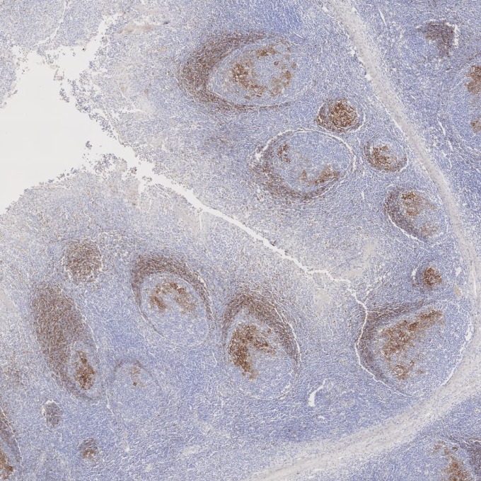 IHC staining of human tonsillitis using 60208-2-Ig