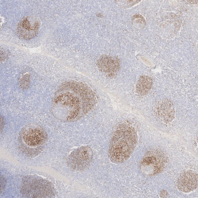 IHC staining of human tonsillitis using 60208-2-Ig
