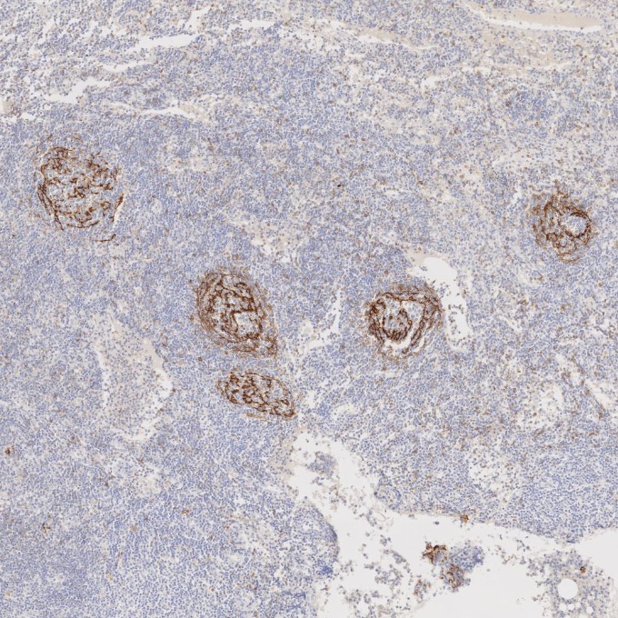 IHC staining of human lymphoma using 60208-2-Ig