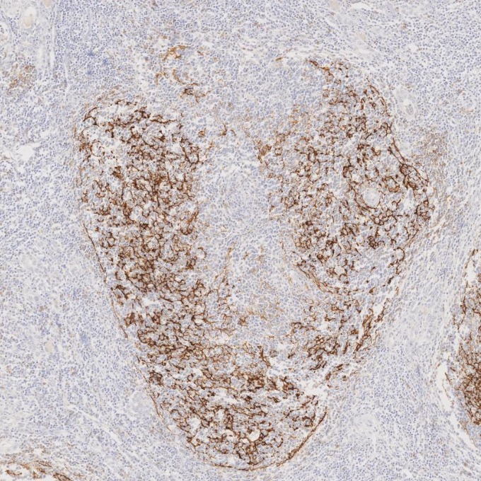 IHC staining of human lymphoma using 60208-2-Ig