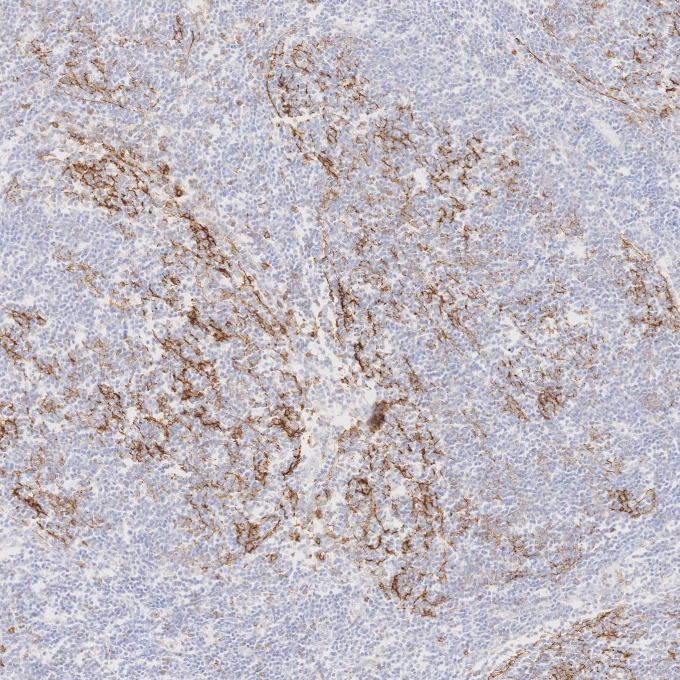 IHC staining of human lymphoma using 60208-2-Ig