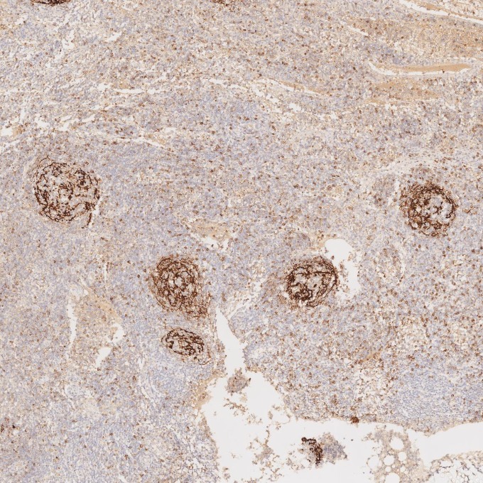 IHC staining of human lymphoma using 60208-2-Ig