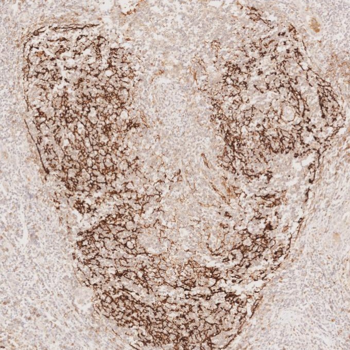 IHC staining of human lymphoma using 60208-2-Ig