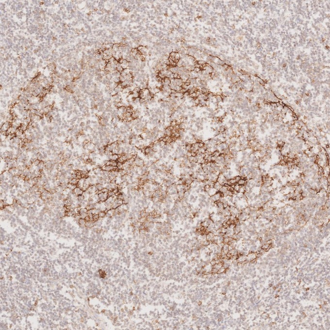 IHC staining of human lymphoma using 60208-2-Ig