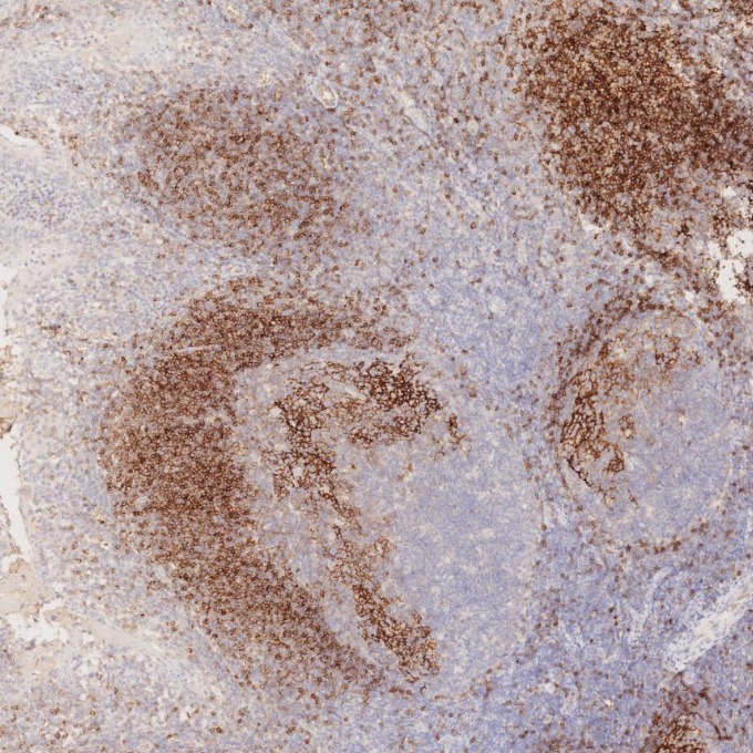 IHC staining of human tonsillitis using 60208-2-Ig