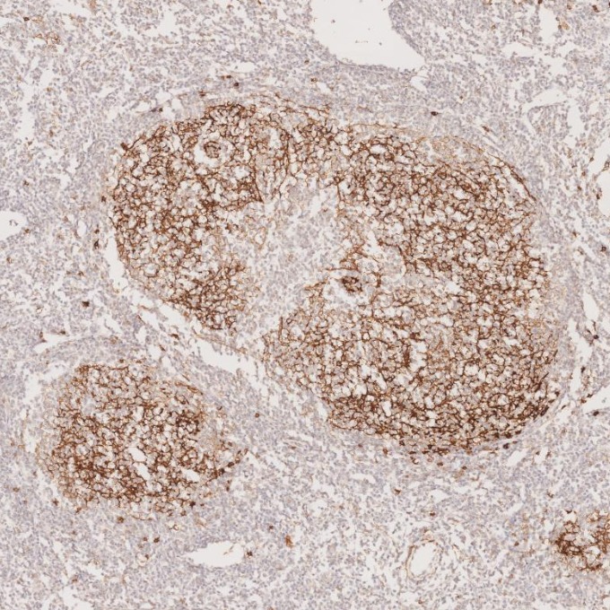 IHC staining of human lymphoma using 60208-2-Ig