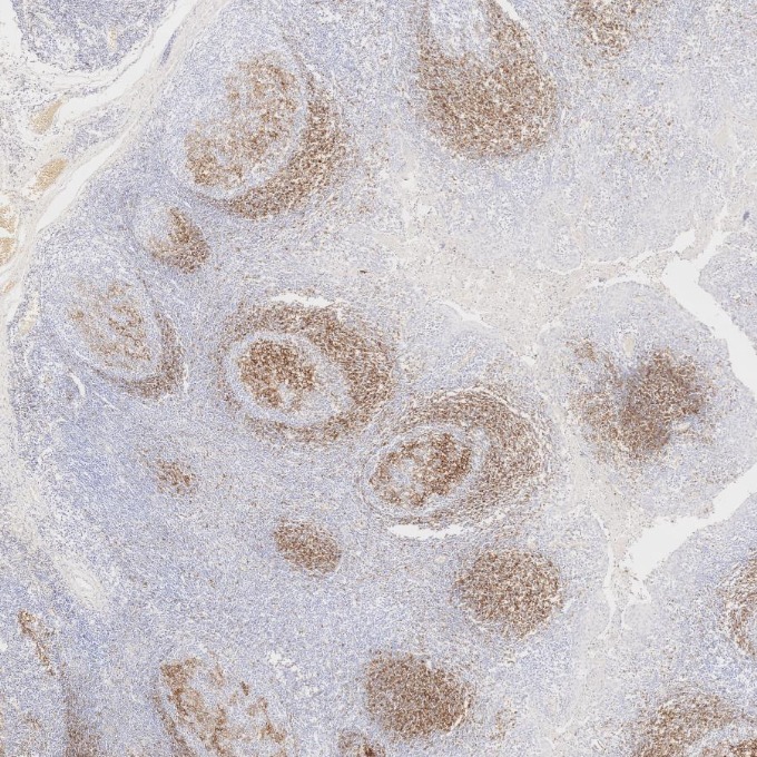IHC staining of human tonsillitis using 60208-2-Ig