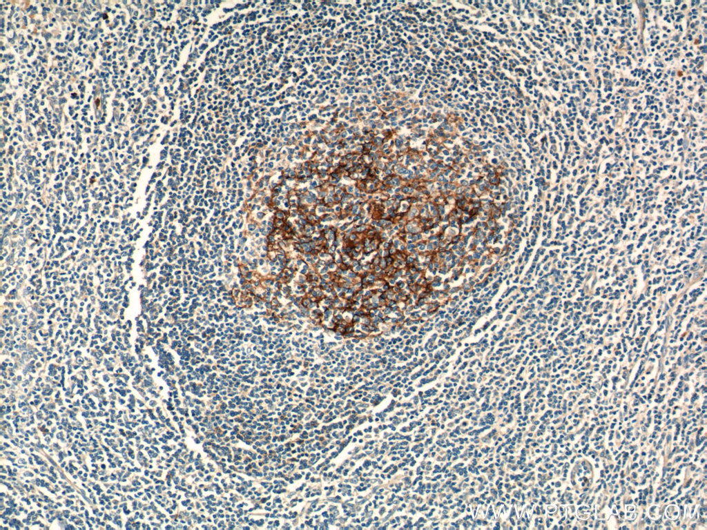 IHC staining of human tonsillitis using 18642-1-AP