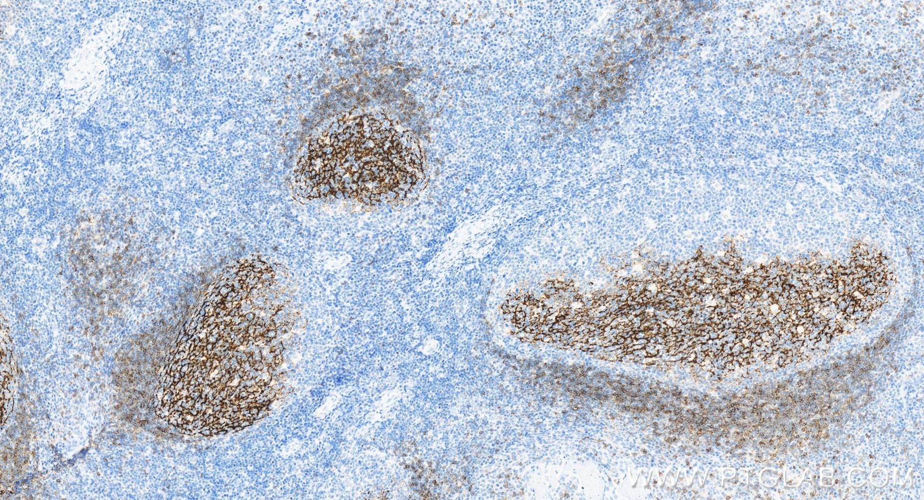IHC staining of human tonsillitis using 84024-2-RR