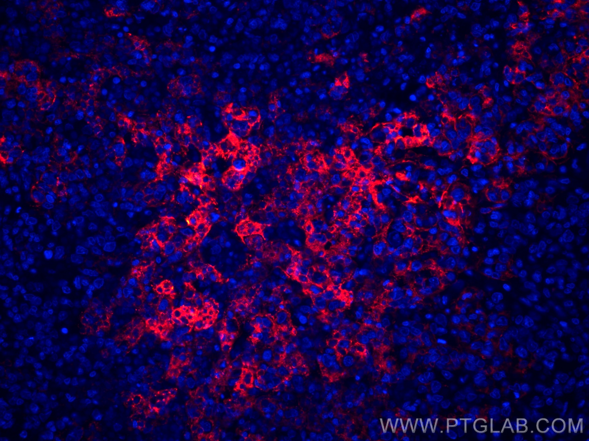 IF Staining of human lymphoma using CL594-60208