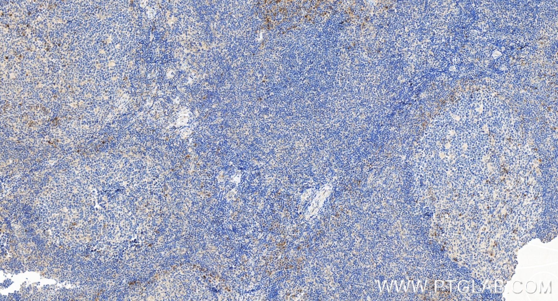 IHC staining of human tonsillitis using 84086-1-RR