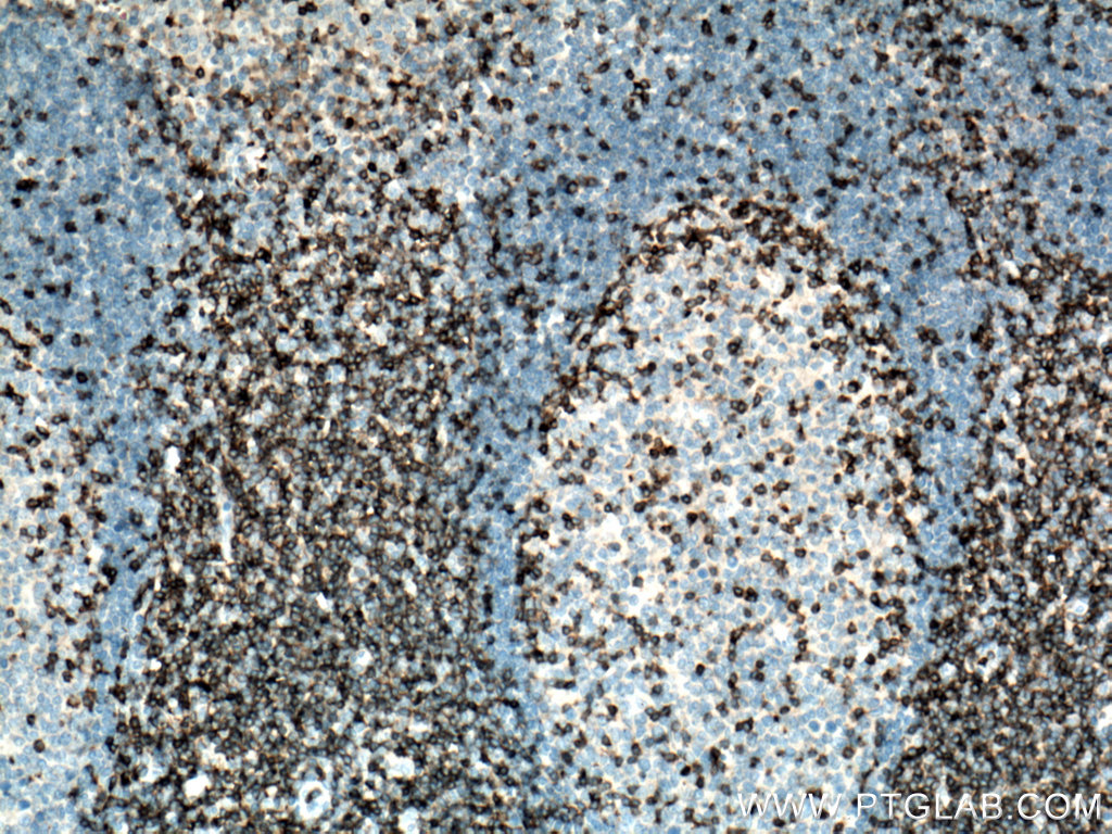 IHC staining of human tonsillitis using 12837-2-AP