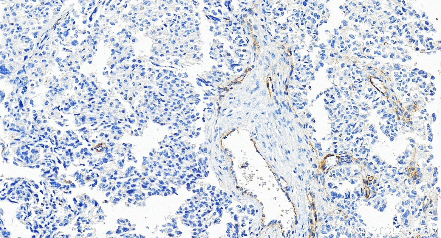 IHC staining of human ovary cancer using 18160-1-AP