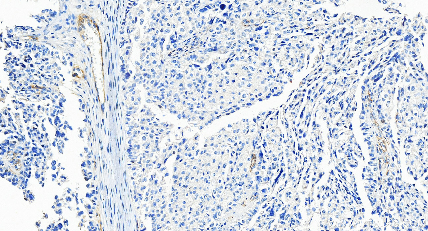 IHC staining of human ovary cancer using 18160-1-AP