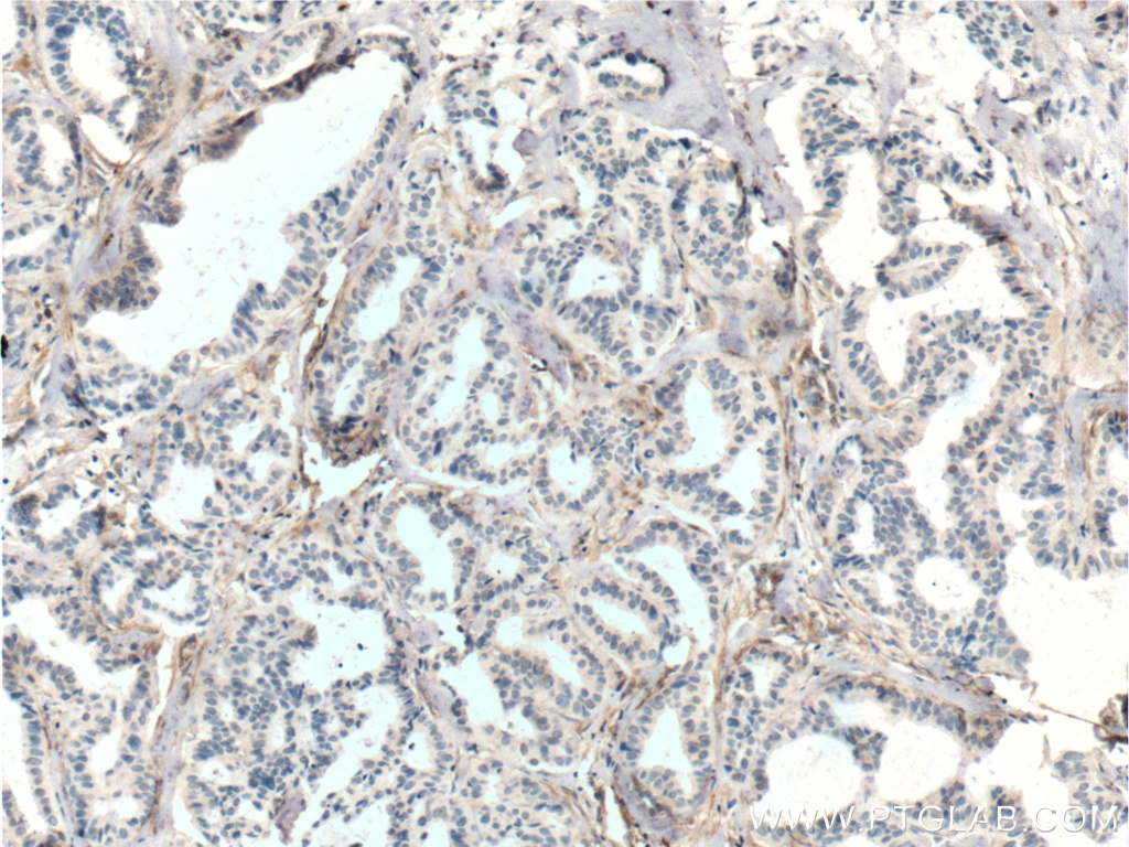 IHC staining of human breast cancer using 60170-1-Ig (same clone as 60170-1-PBS)