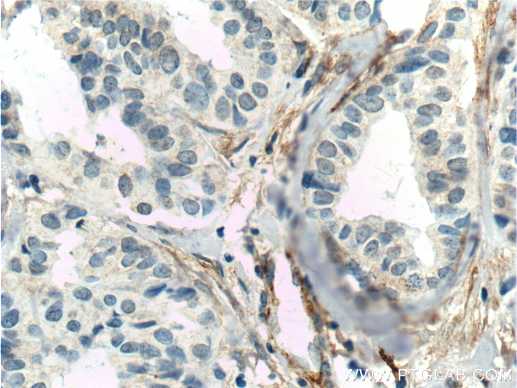 IHC staining of human breast cancer using 60170-1-Ig (same clone as 60170-1-PBS)