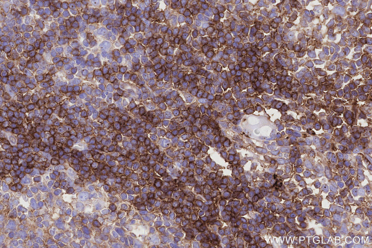 IHC staining of human tonsillitis using 60763-7-Ig IHC staining of human tonsillitis using 60763-7-Ig