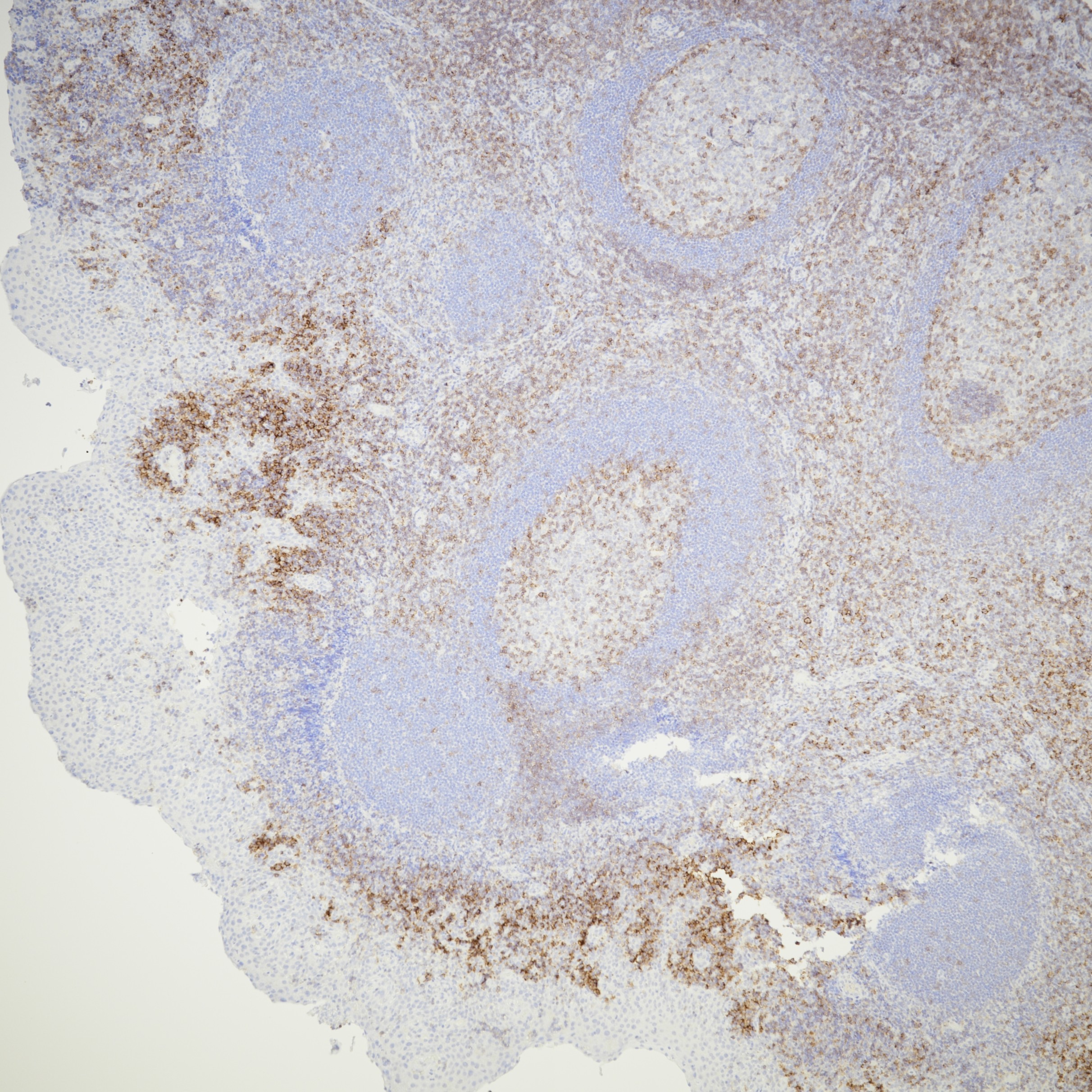 IHC staining of human tonsil using 66308-1-Ig IHC staining of human tonsil using 66308-1-Ig
