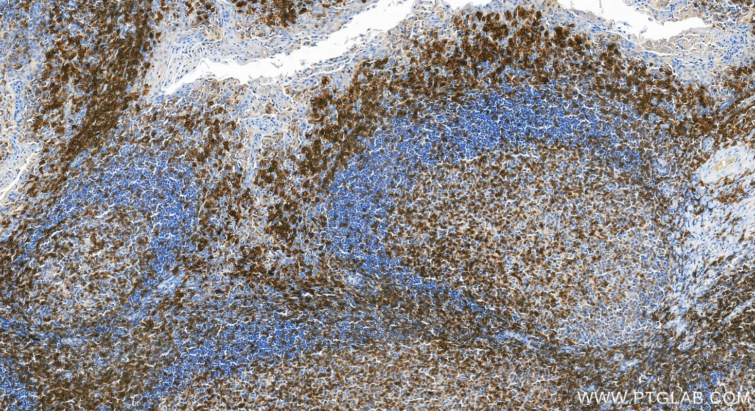 Immunohistochemical analysis of paraffin-embedded human tonsillitis tissue slide using 85066-5-RR (CD27 antibody) at dilution of 1:500 (under 20x lens). Heat mediated antigen retrieval with Tris-EDTA buffer (pH 9.0). IHC staining of human tonsillitis using 85066-5-RR