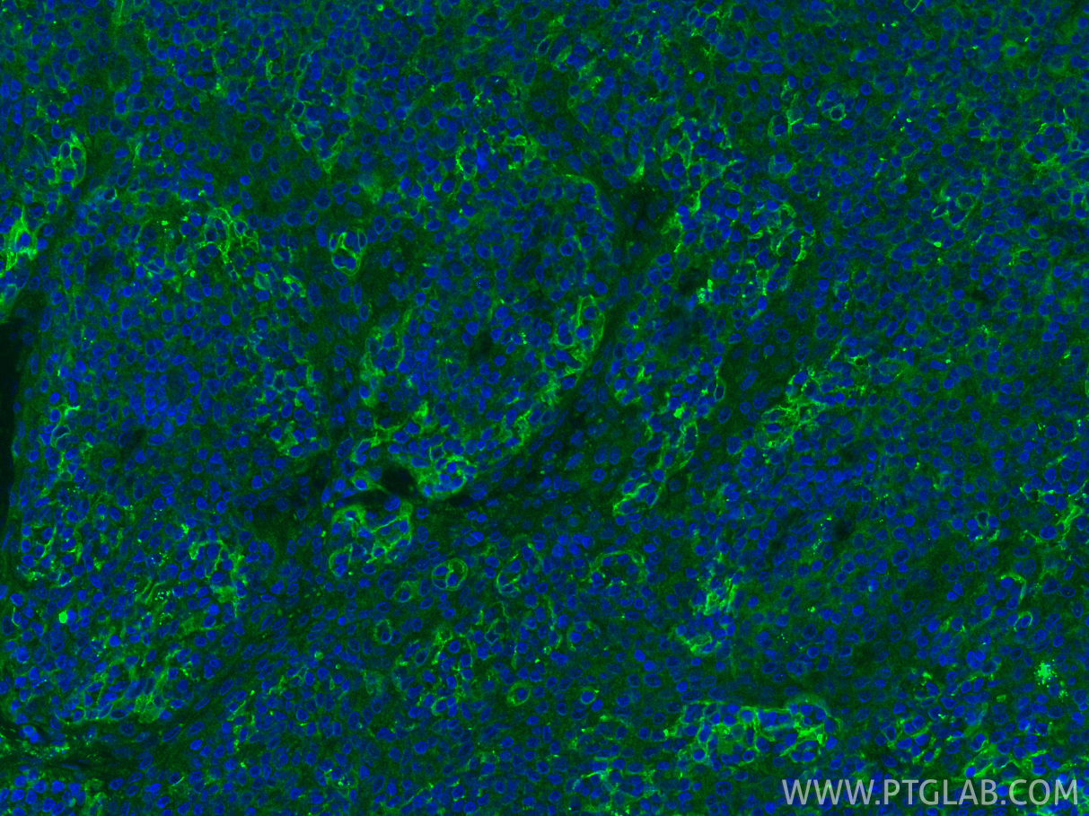 Immunofluorescent analysis of (4% PFA) fixed paraffin-embedded human tonsillitis tissue using PD-L1/CD274 antibody (17952-1-AP) at dilution of 1:200 and CoraLite®488-Conjugated Goat Anti-Rabbit IgG(H+L) (<a class='green' href='/productredirect?CatalogNo=SA00013-2' target='_blank'>SA00013-2</a>). Heat mediated antigen retrieval with Tris-EDTA buffer (pH 9.0). IF Staining of human tonsillitis using 17952-1-AP