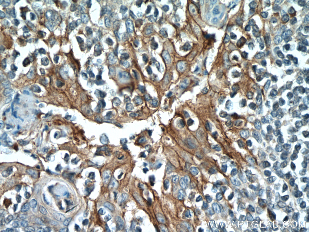 IHC staining of human tonsillitis using 17952-1-AP