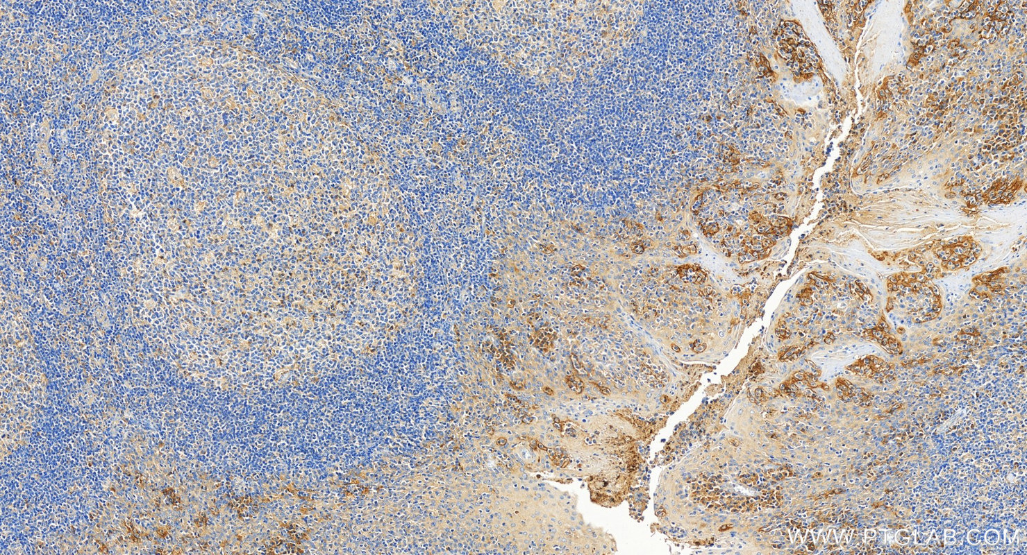 IHC staining of human tonsillitis using 17952-1-AP