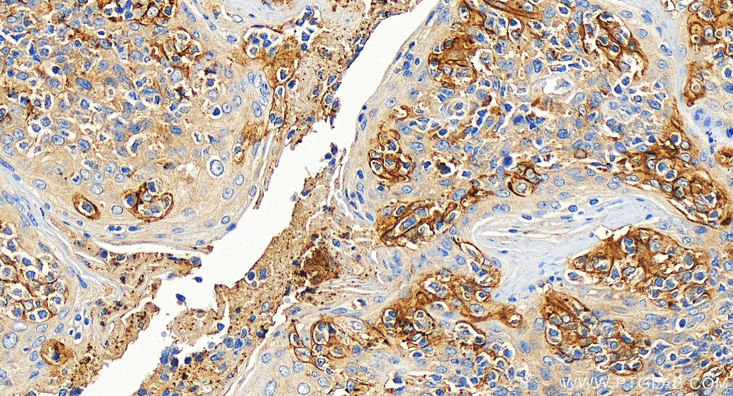 IHC staining of human tonsillitis using 17952-1-AP