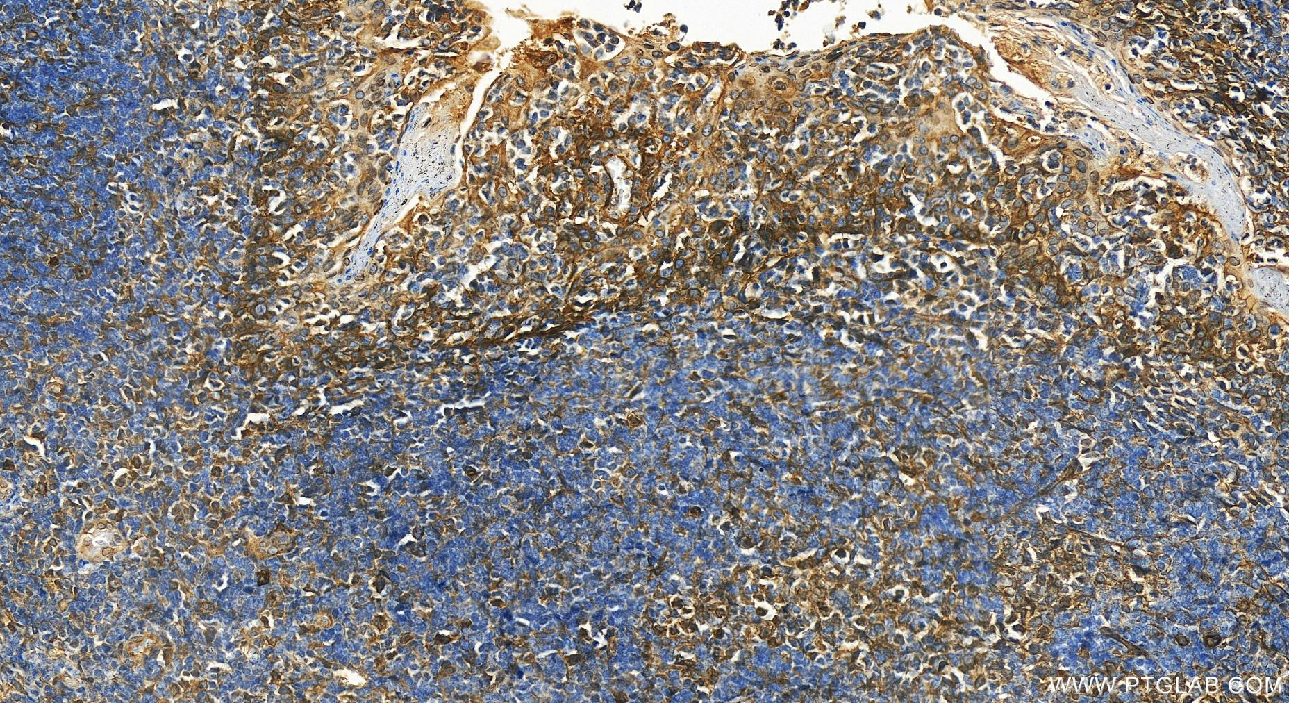 IHC staining of human tonsillitis using 14453-1-AP