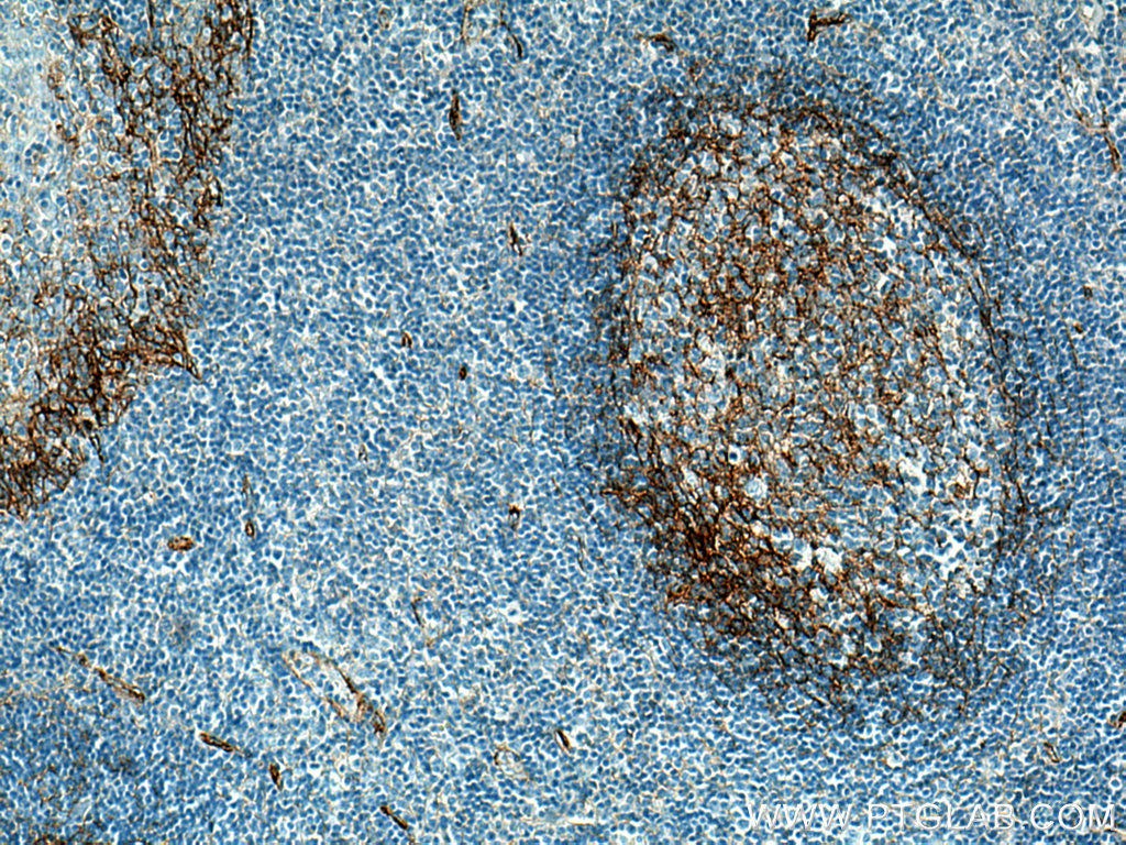 IHC staining of human tonsillitis using 66481-1-Ig (same clone as 66481-1-PBS)