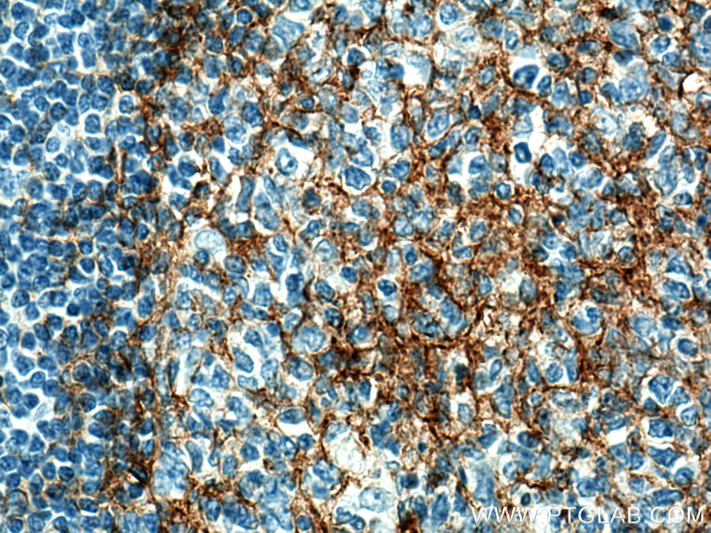 IHC staining of human tonsillitis using 66481-1-Ig (same clone as 66481-1-PBS)