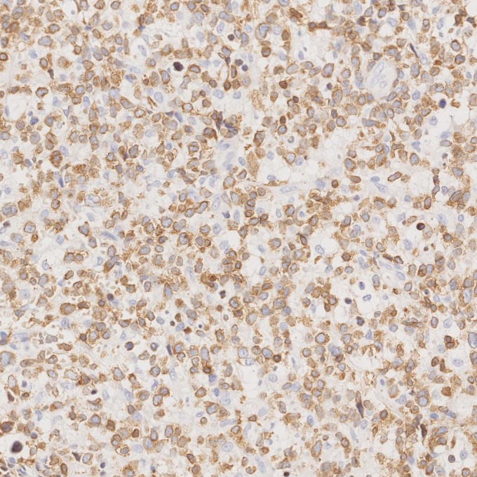 IHC staining of human lymphoma using 81324-1-RR IHC staining of human lymphoma using 81324-1-RR