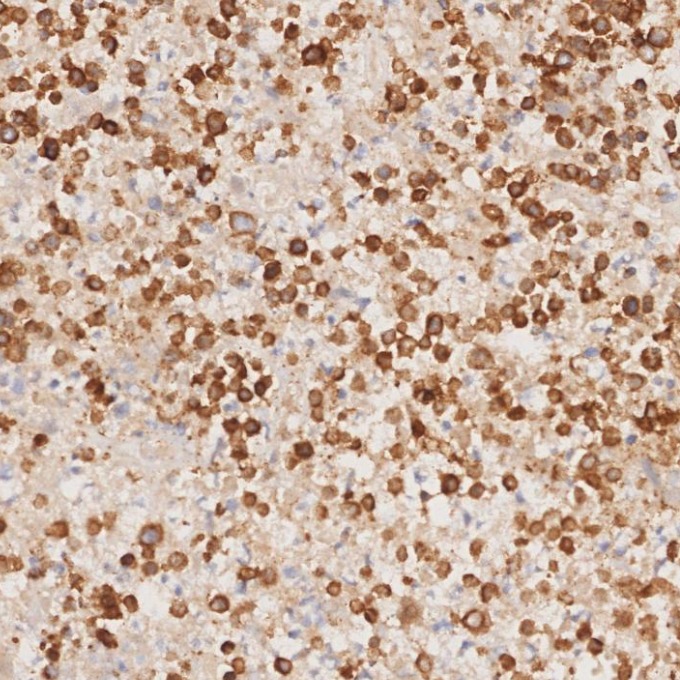 IHC staining of human lymphoma using 81324-1-RR IHC staining of human lymphoma using 81324-1-RR