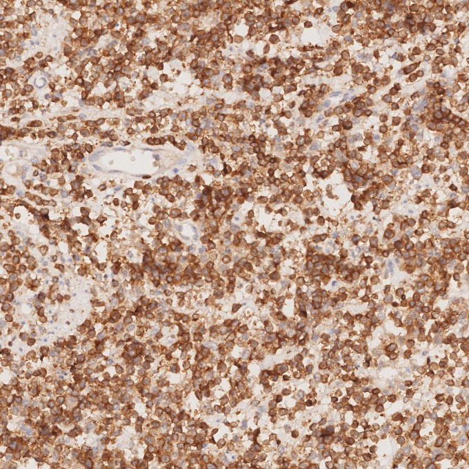 IHC staining of human lymphoma using 81324-1-RR IHC staining of human lymphoma using 81324-1-RR