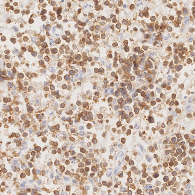 IHC staining of human lymphoma using 81324-1-RR IHC staining of human lymphoma using 81324-1-RR