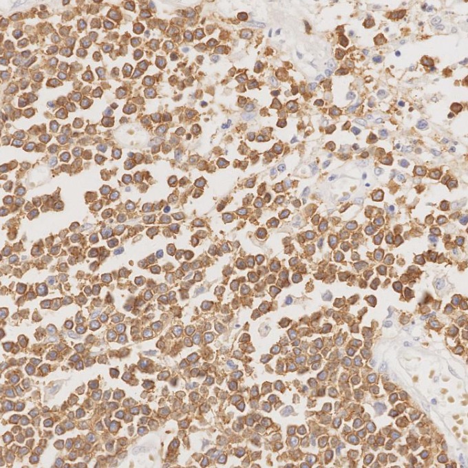 IHC staining of human lymphoma using 81324-1-RR IHC staining of human lymphoma using 81324-1-RR
