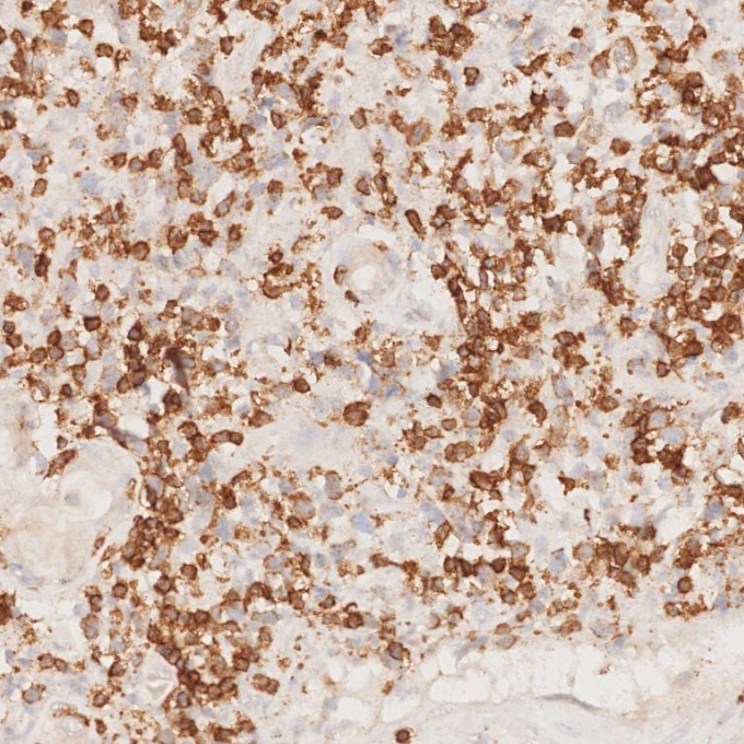IHC staining of human lymphoma using 81324-1-RR IHC staining of human lymphoma using 81324-1-RR